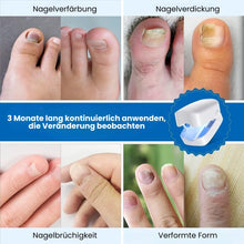 Lade das Bild in den Galerie-Viewer, DermaNail - patentierte Nagelpilz-Therapie - für gesunde Nägel innerhalb von 4 Wochen