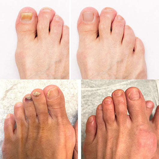 DermaNail - patentierte Nagelpilz-Therapie - für gesunde Nägel innerhalb von 4 Wochen