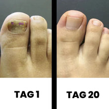 Lade das Bild in den Galerie-Viewer, DermaNail - patentierte Nagelpilz-Therapie - für gesunde Nägel innerhalb von 4 Wochen
