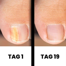 Lade das Bild in den Galerie-Viewer, DermaNail - patentierte Nagelpilz-Therapie - für gesunde Nägel innerhalb von 4 Wochen
