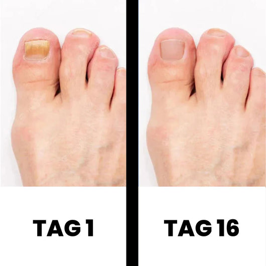 DermaNail - patentierte Nagelpilz-Therapie - für gesunde Nägel innerhalb von 4 Wochen