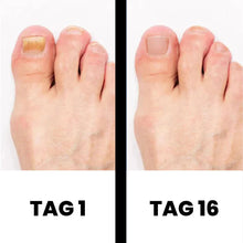 Lade das Bild in den Galerie-Viewer, DermaNail - patentierte Nagelpilz-Therapie - für gesunde Nägel innerhalb von 4 Wochen
