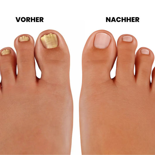 PureNail - patentierte Nagelpilz-Therapie - für gesunde Nägel innerhalb von 4 Wochen